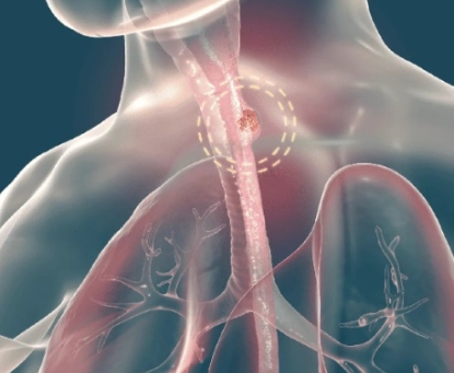 Ung thư thực quản có thể phát hiện sớm không?